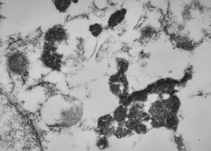 M,66y. | hemosiderin - siderosomes M,66y. | hemosiderin - siderosomes